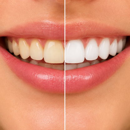 LED Teeth Whitening Kit